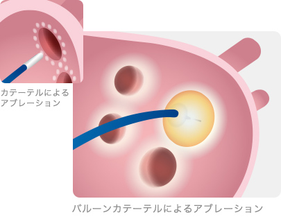 アブレーション カテーテル