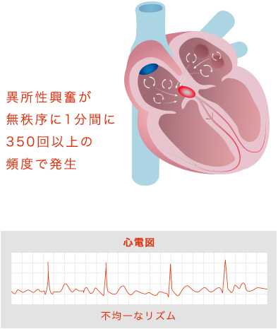 心房細動