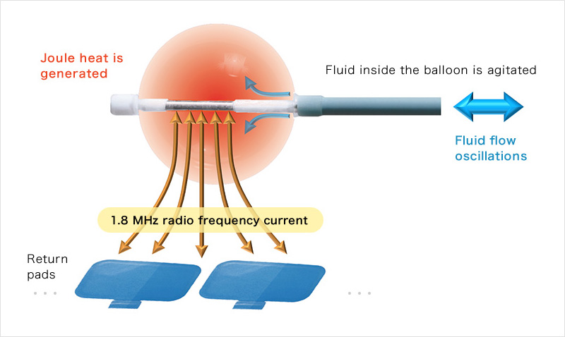 How the Catheter Ablation System works